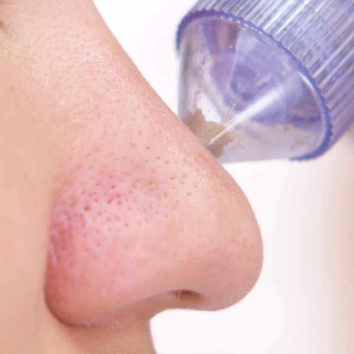 Limpiador Facial Poros Puntos Negros Quita Granos - Imagen 3